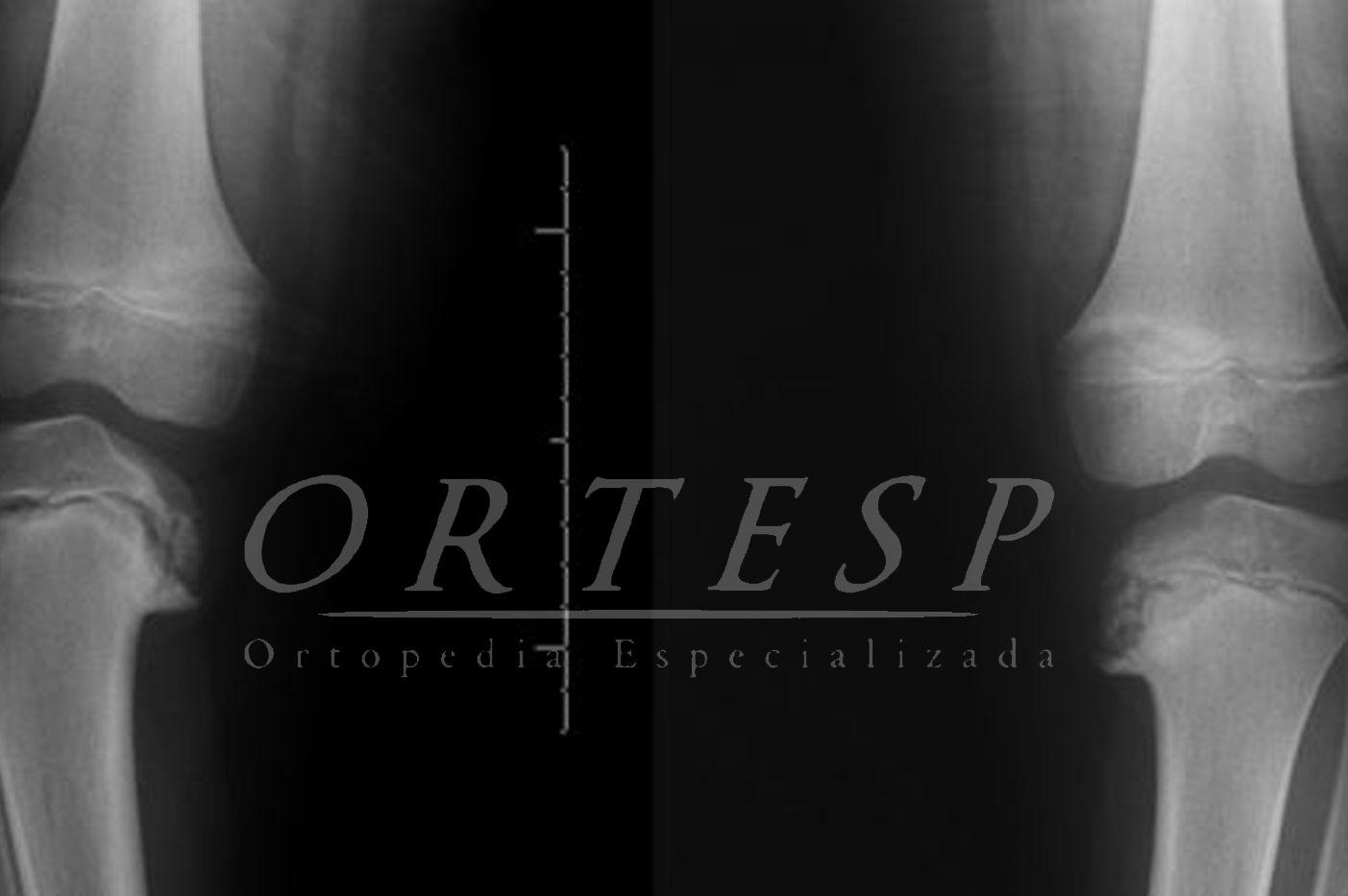 Doença de Blount: possíveis causas e principais sintomas