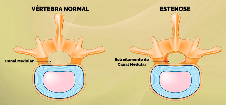 compreendendo a estenose do canal vertebral