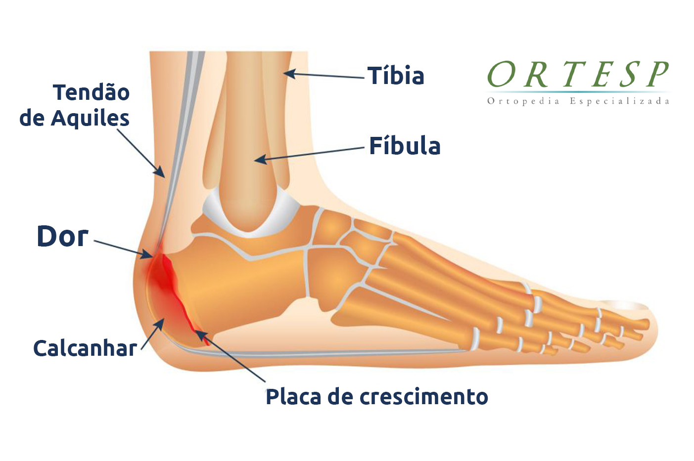 Dor no calcanhar: você conhece a Doença de Sever?