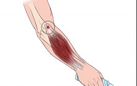 Epicondilite lateral: a causa escondida da dor no cotovelo
