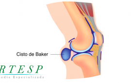 Cisto de baker, conheça sua causa!