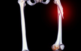 Fratura de fêmur: quando é necessária a cirurgia?