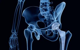 Artroplastia / Prótese de Quadril