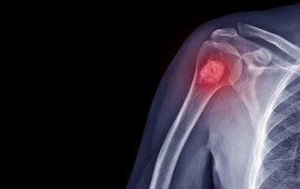 Como funciona o tratamento para tumor ósseo: opções e procedimentos