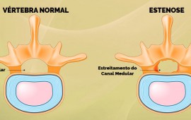 Compreendendo a Estenose do Canal Vertebral