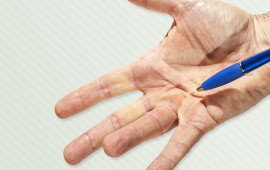 Contratura de Dupuytren
