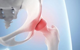 Osteonecrose da cabeça femoral