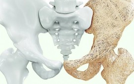 Osteoporose