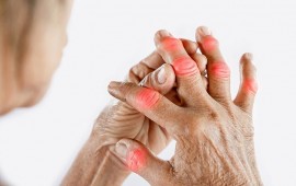 Sinais iniciais da artrose nas mãos que não devem ser ignorados