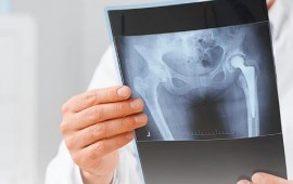 Tratamentos para displasia de quadril