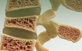 Como é o diagnóstico de osteoporose?