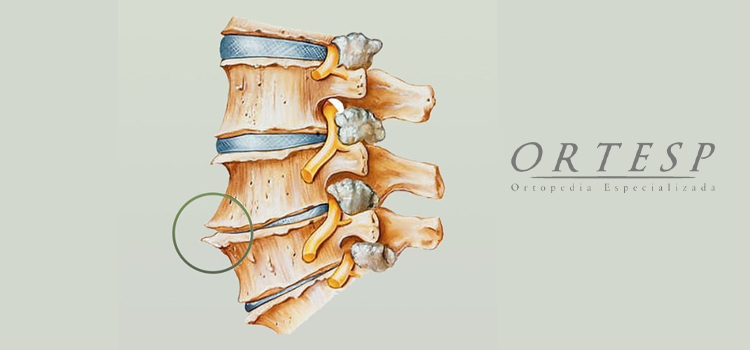 o que são osteófitos ortesp ortopedia