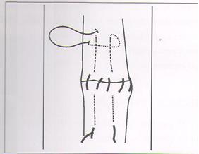 Esquema sutura