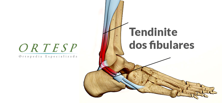 tendinite dos fibulares